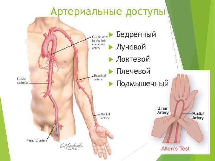 Артериальные доступы Бедренный Лучевой Локтевой Плечевой Подмышечный 