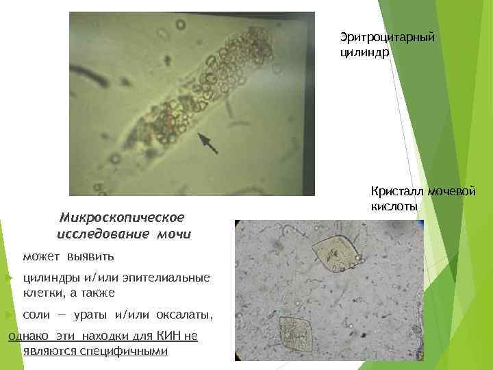 Эритроцитарный цилиндр Микроскопическое исследование мочи может выявить цилиндры и/или эпителиальные клетки, а также соли