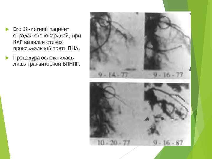  Его 38 -летний пациент страдал стенокардией, при КАГ выявлен стеноз проксимальной трети ПНА.