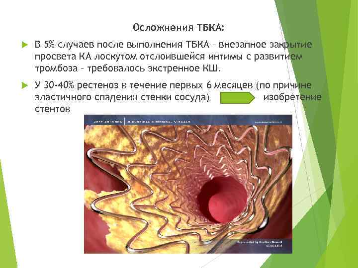 Осложнения ТБКА: В 5% случаев после выполнения ТБКА – внезапное закрытие просвета КА лоскутом