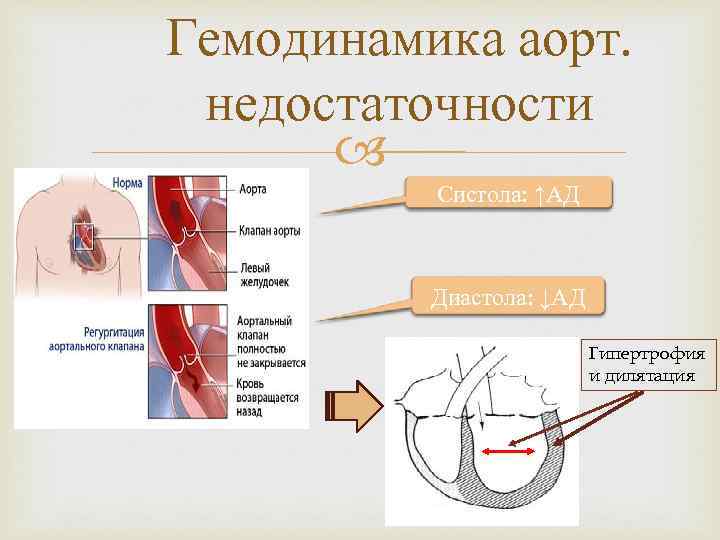 Аортальная недостаточность презентация