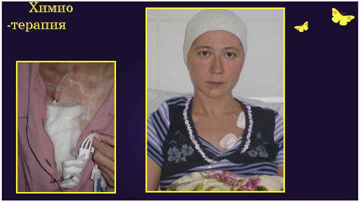 Химио -терапия 