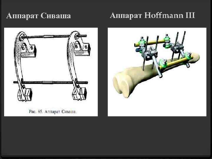 Аппарат Сиваша Аппарат Hoffmann III 