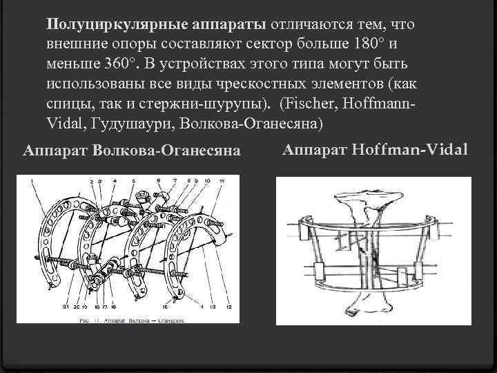 Внеочаговый остеосинтез презентация