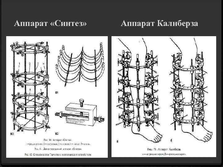 Аппарат «Синтез» Аппарат Калнберза 