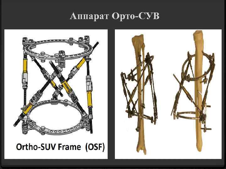 Аппарат Орто-СУВ 