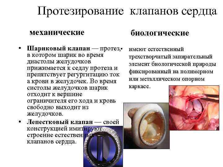  Протезирование клапанов сердца механические • Шариковый клапан — протез, • в котором шарик