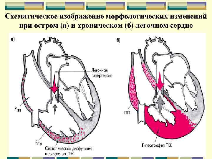 Схематическое изображение морфологических изменений при остром (а) и хроническом (б) легочном сердце 