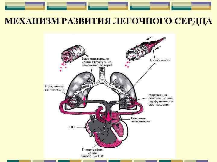 МЕХАНИЗМ РАЗВИТИЯ ЛЕГОЧНОГО СЕРДЦА 