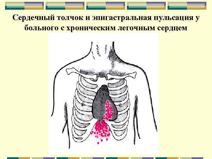 Сердечный толчок и эпигастральная пульсация у больного с хроническим легочным сердцем 