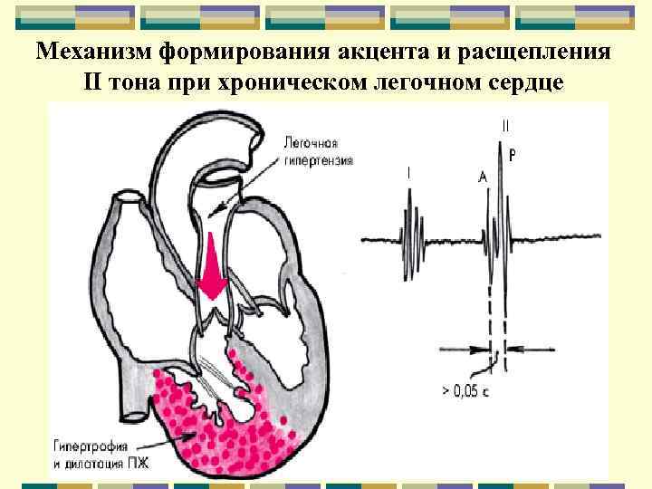 Механизм формирования акцента и расщепления II тона при хроническом легочном сердце 