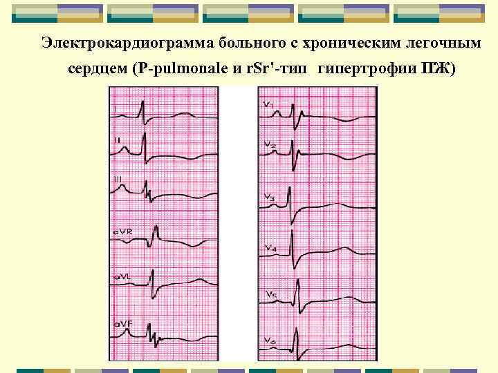 Электрокардиограмма больного с хроническим легочным сердцем (Р-pulmonale и r. Sr'-тип гипертрофии ПЖ) 