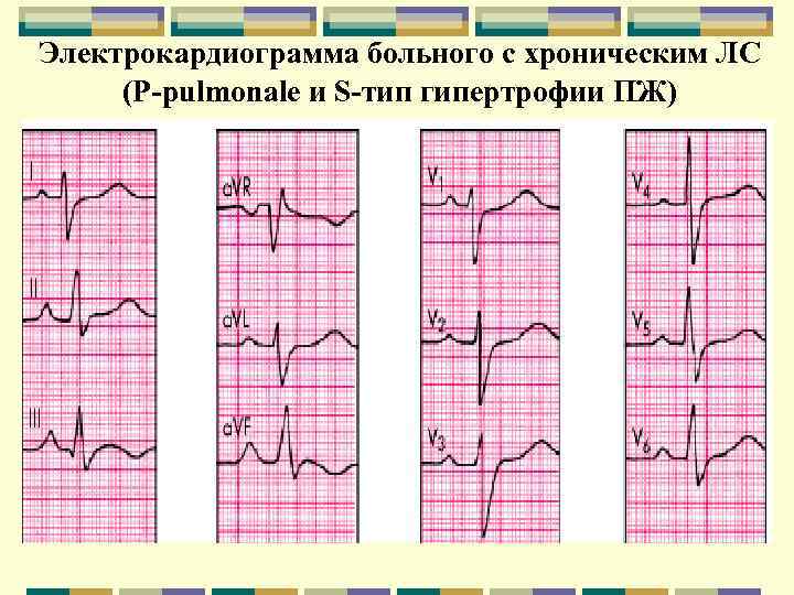 Электрокардиограмма больного с хроническим ЛС (Р-pulmonale и S-тип гипертрофии ПЖ) 