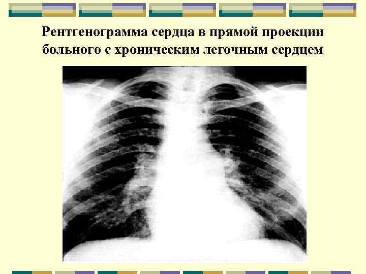 Рентгенограмма сердца в прямой проекции больного с хроническим легочным сердцем 