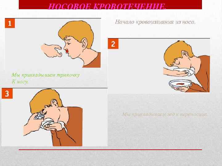 НОСОВОЕ КРОВОТЕЧЕНИЕ. Начало кровоизлияния из носа. Мы прикладываем тряпочку К носу. Мы прикладываем лед
