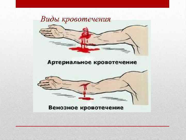 Виды кровотечения 