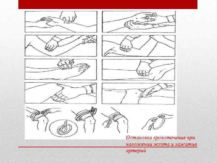 Остановка кровотечения при наложении жгута и зажатия артерий 