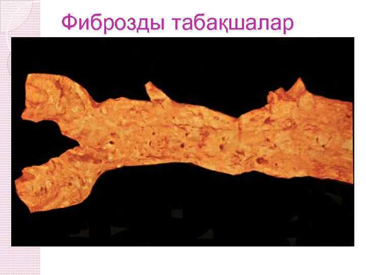Фиброзды табақшалар 