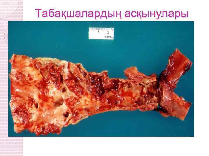 Табақшалардың асқынулары 