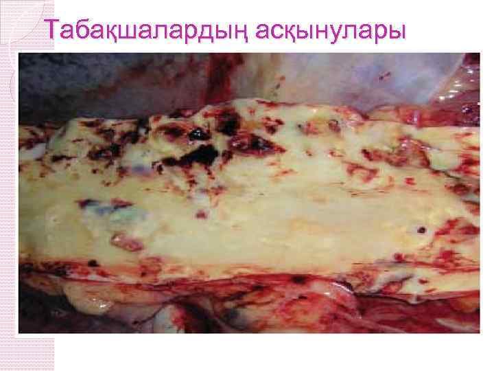 Табақшалардың асқынулары 