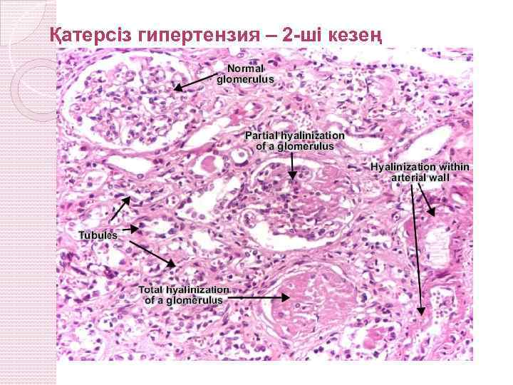 Қатерсіз гипертензия – 2 -ші кезең 