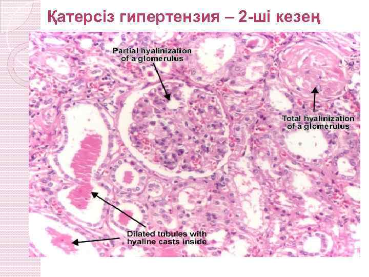 Қатерсіз гипертензия – 2 -ші кезең 