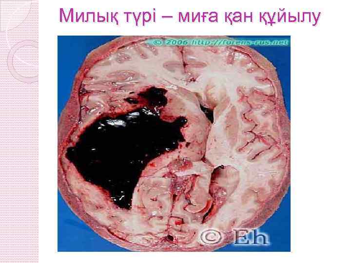 Милық түрі – миға қан құйылу 