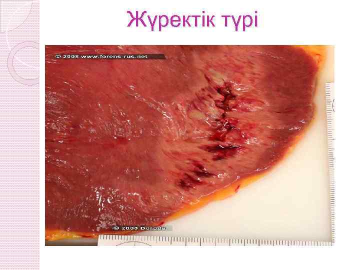 Жүректік түрі 