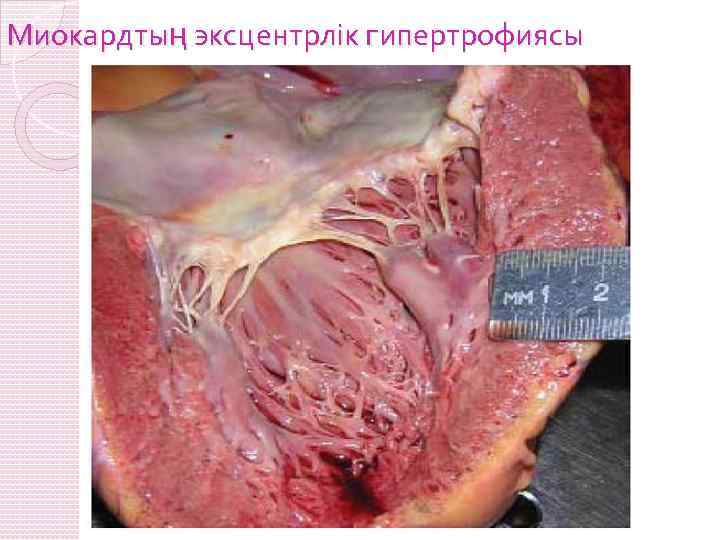 Миокардтың эксцентрлік гипертрофиясы 