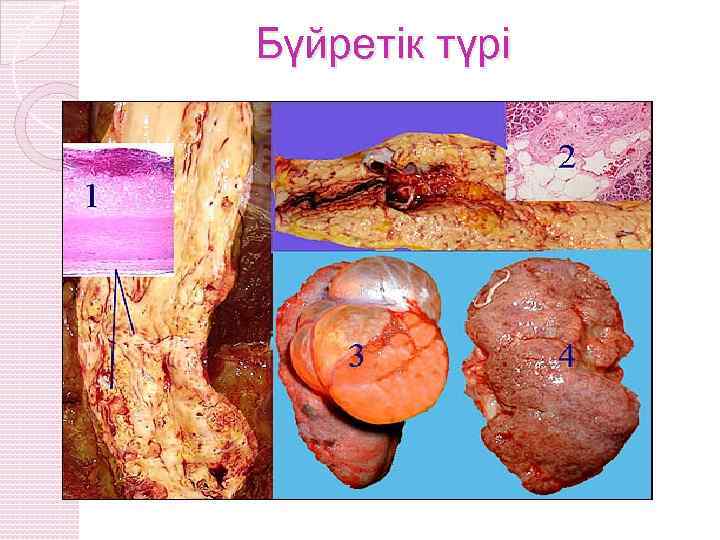 Бүйретік түрі 