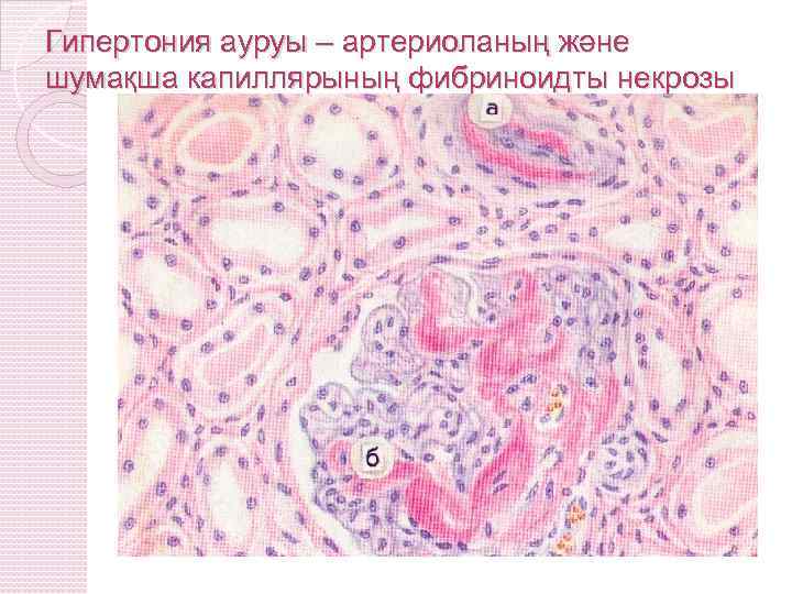 Гипертония ауруы – артериоланың және шумақша капиллярының фибриноидты некрозы 