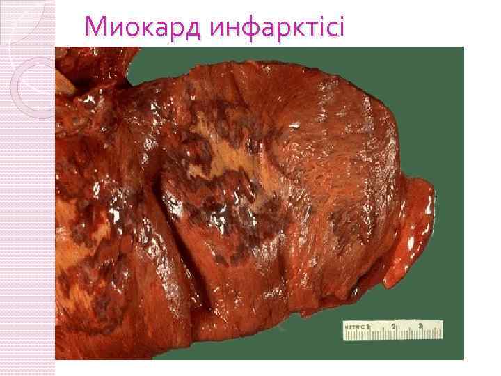 Миокард инфарктісі 