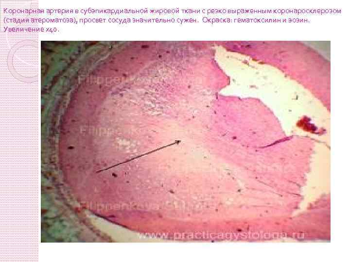 Коронарная артерия в субэпикардиальной жировой ткани с резко выраженным коронаросклерозом (стадия атероматоза), просвет сосуда