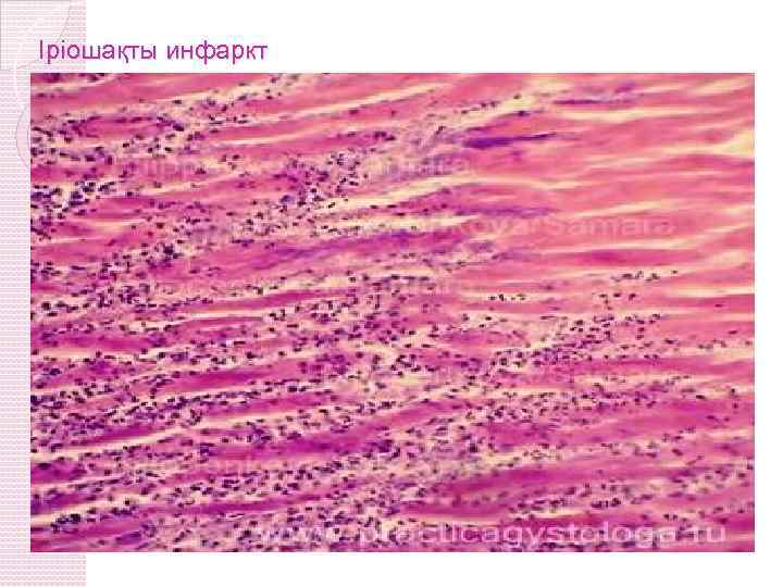 Іріошақты инфаркт 