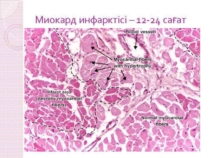 Миокард инфарктісі – 12 -24 сағат 