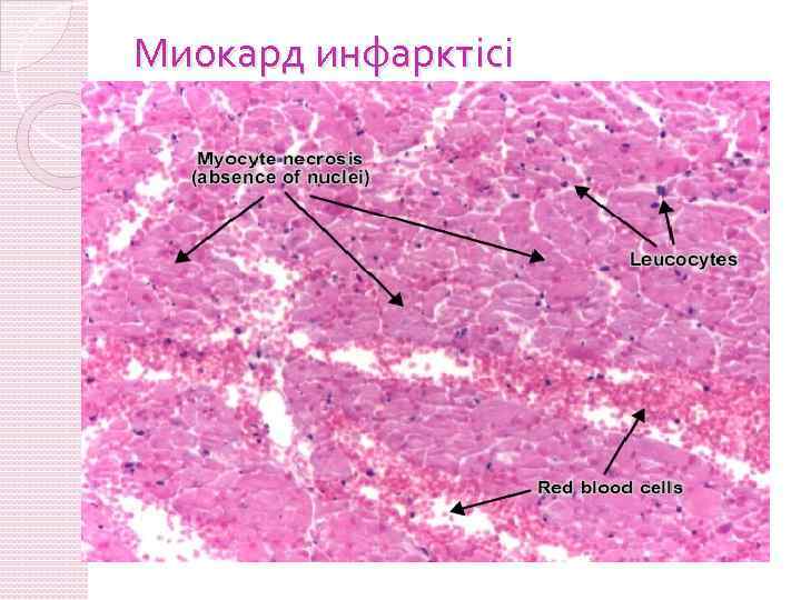 Миокард инфарктісі 