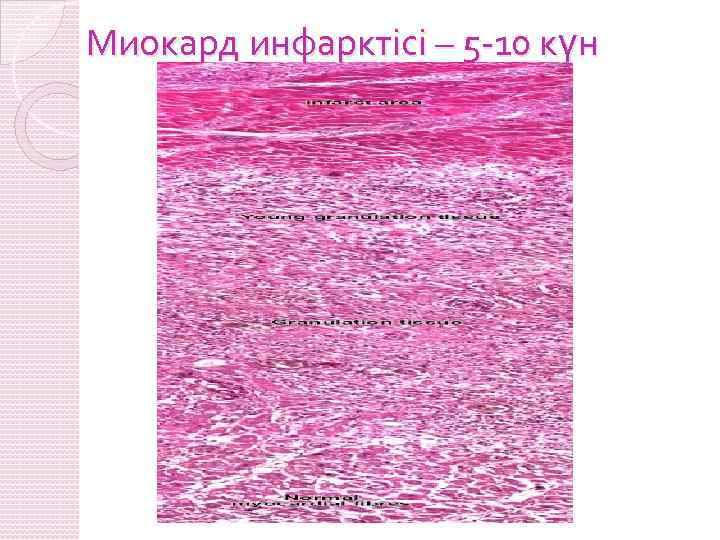 Миокард инфарктісі – 5 -10 күн 