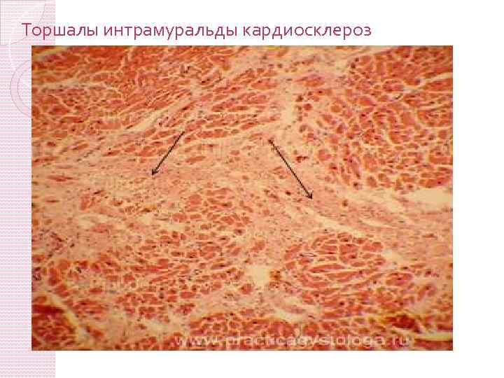 Торшалы интрамуральды кардиосклероз 