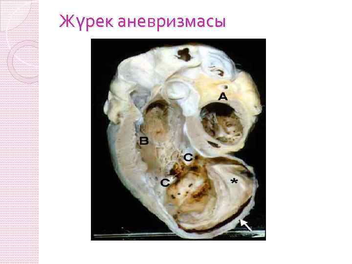 Жүрек аневризмасы 