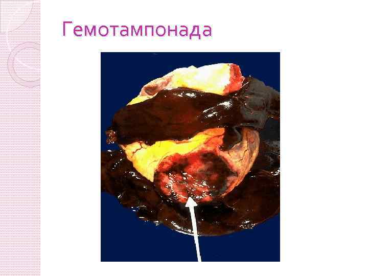 Гемотампонада 