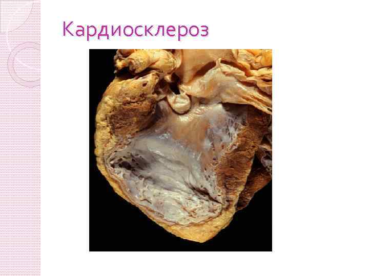 Кардиосклероз 