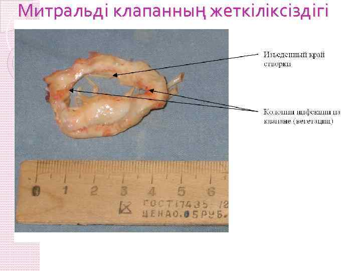 Митральді клапанның жеткіліксіздігі 
