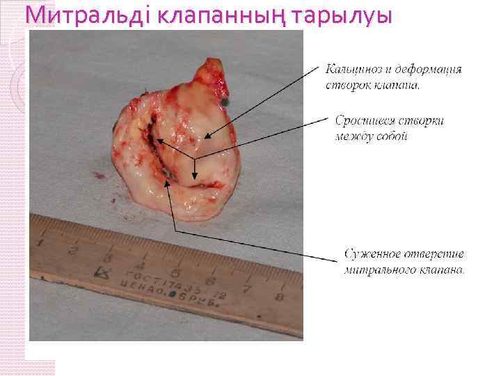 Митральді клапанның тарылуы 