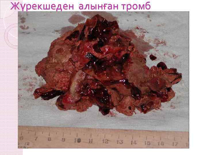 Жүрекшеден алынған тромб 