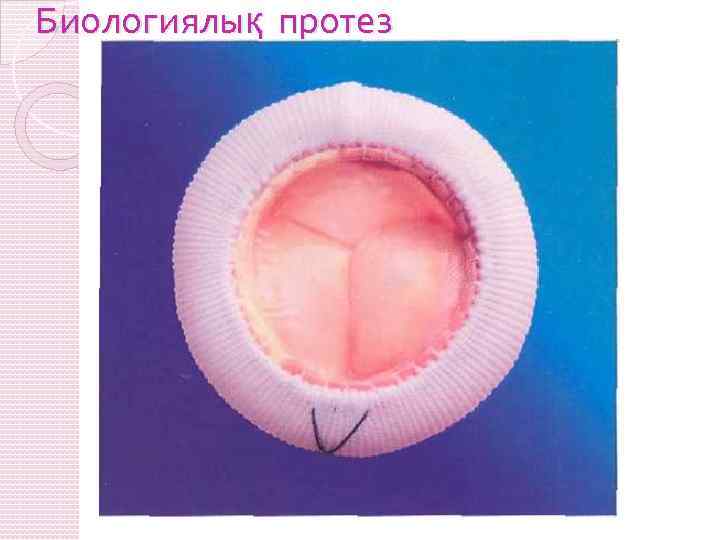 Биологиялық протез 