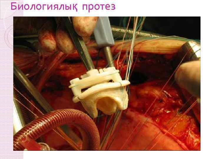 Биологиялық протез 