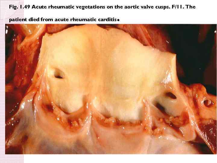 Fig. 1. 49 Acute rheumatic vegetations on the aortic valve cusps. F/11. The .