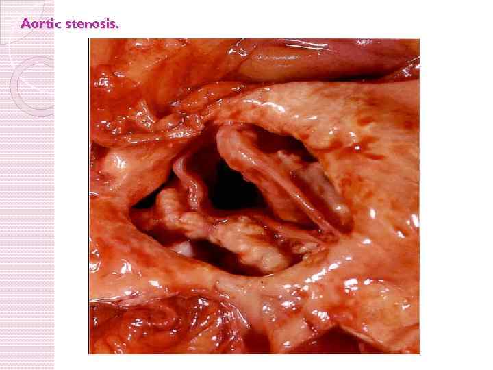 Aortic stenosis. 