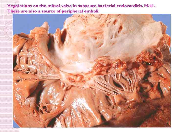 Vegetations on the mitral valve in subacute bacterial endocarditis. M/41. These are also a