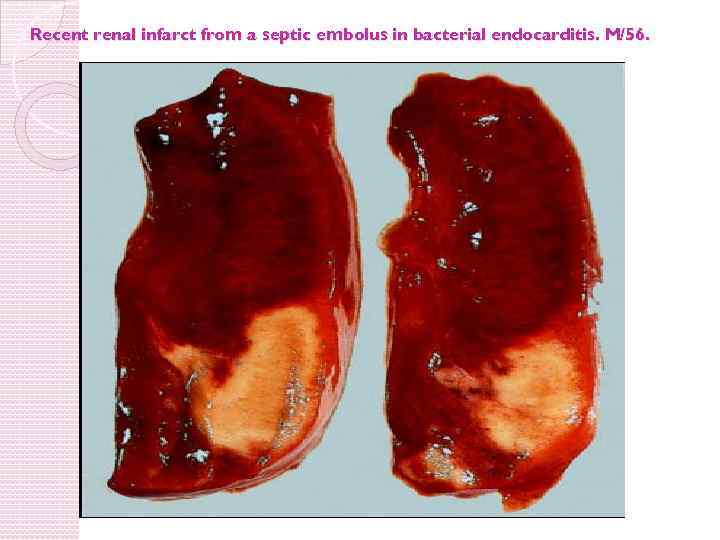 Recent renal infarct from a septic embolus in bacterial endocarditis. M/56. 